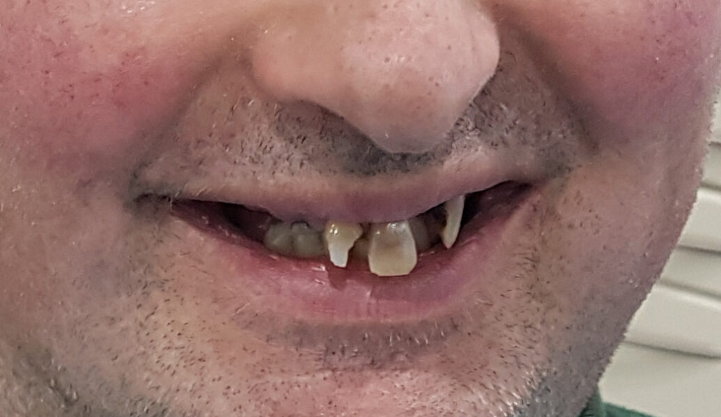 Before - Denpure Dental