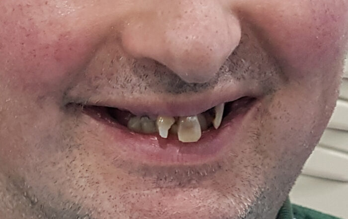 Before - Denpure Dental