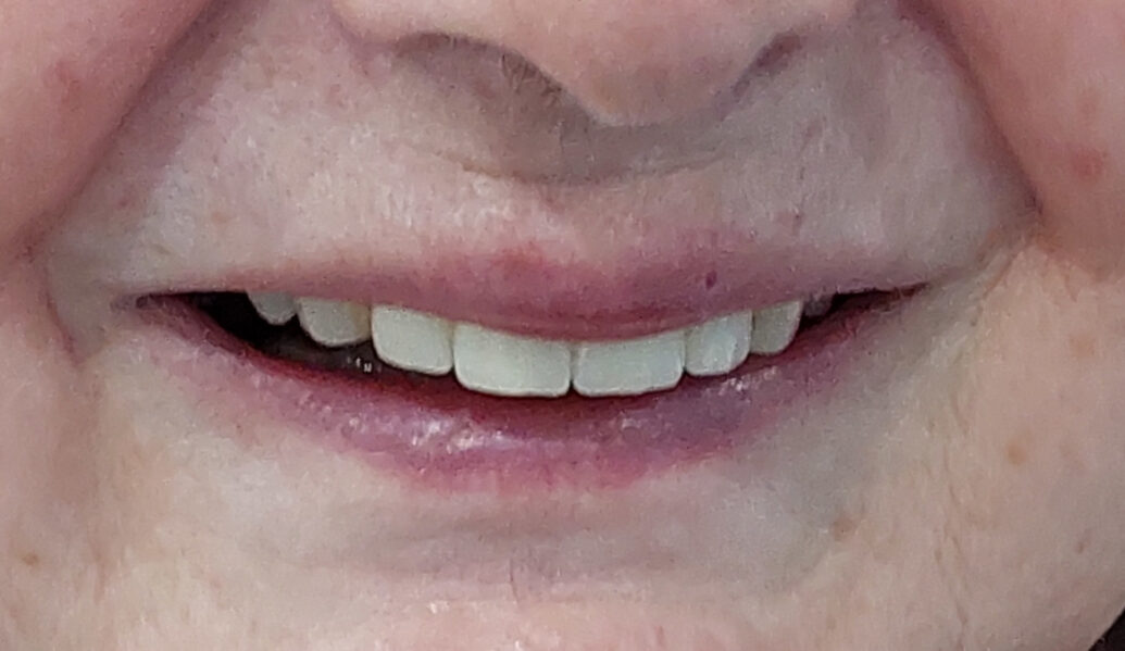 After - Denpure Dental