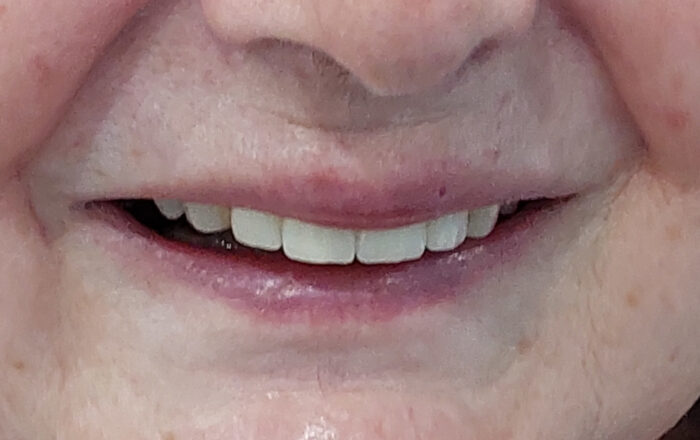 After - Denpure Dental