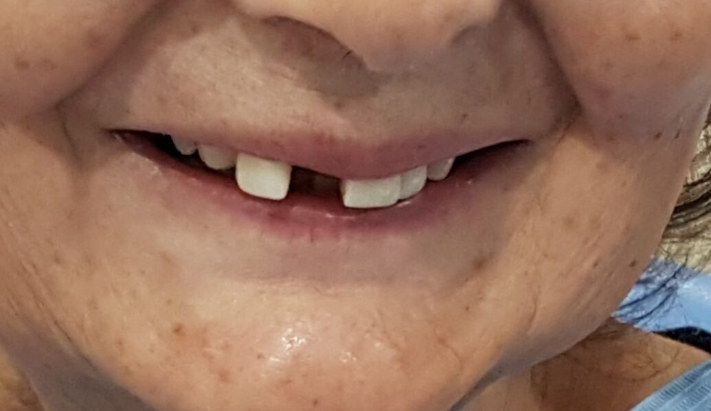 Before - Denpure Dental