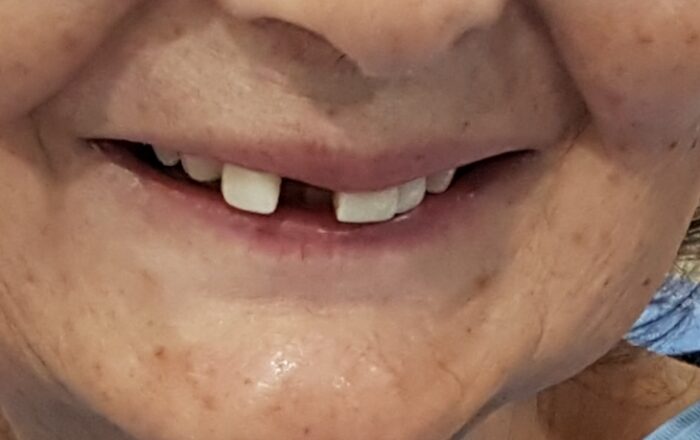 Before - Denpure Dental