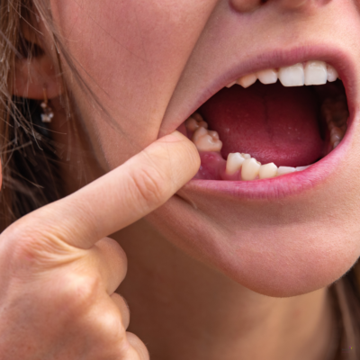 blog - Denpure Dental