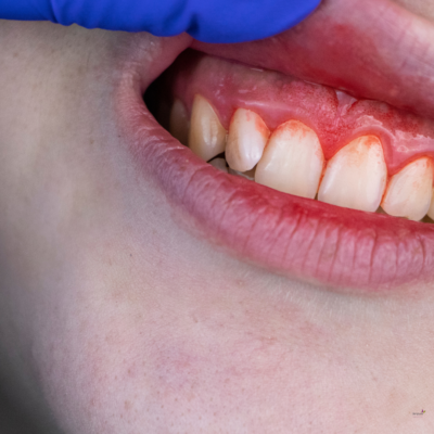 blog - Denpure Dental
